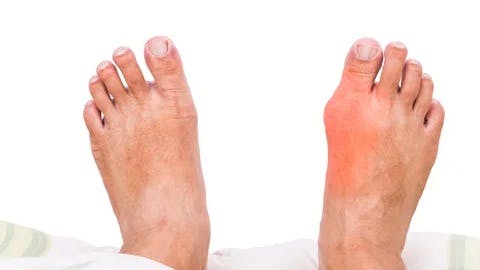 depositphotos_104315068-stock-photo-right-foot-with-painful-swollen